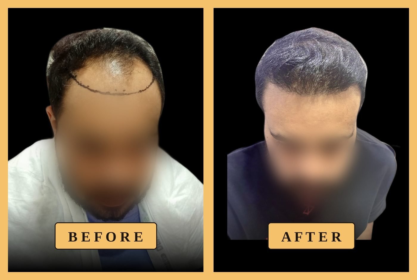 حالة زراعة خط الشعر الأمامي، قبل وبعد
