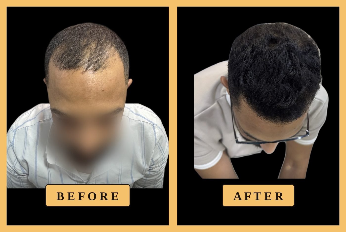 حالة زراعة خط الشعر الأمامي، قبل وبعد